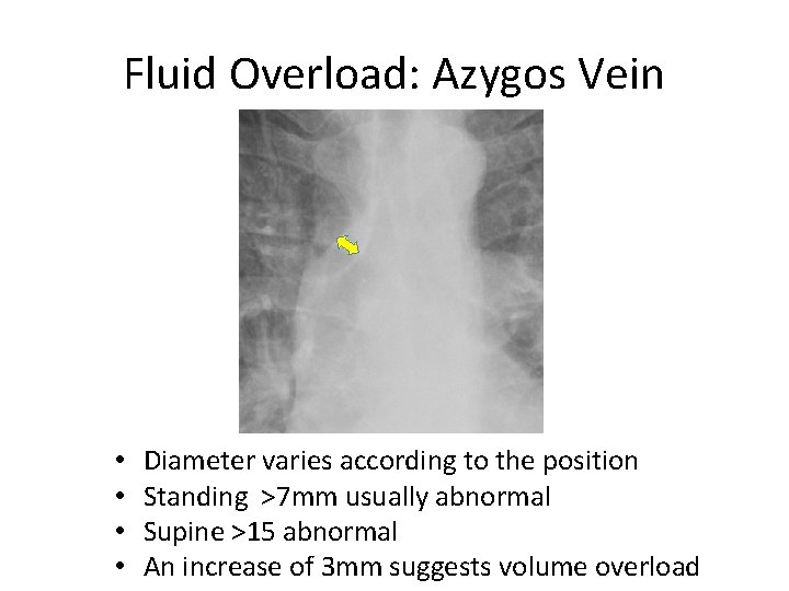 Fluid Overload: Azygos Vein • • Diameter varies according to the position Standing >7