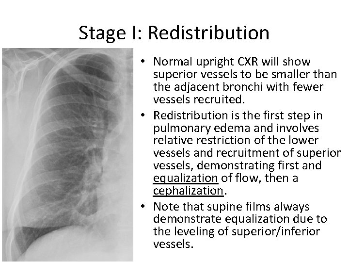 Stage I: Redistribution • Normal upright CXR will show superior vessels to be smaller