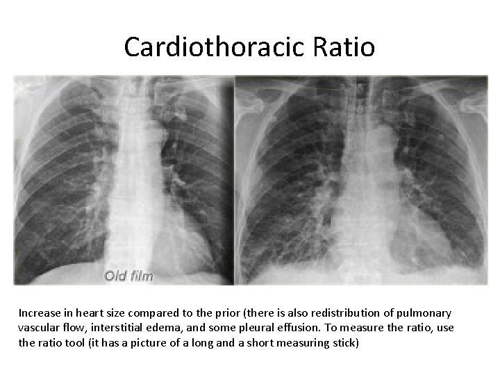 Cardiothoracic Ratio Increase in heart size compared to the prior (there is also redistribution