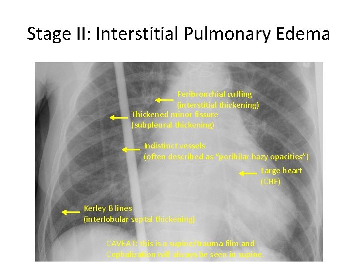 Stage II: Interstitial Pulmonary Edema Peribronchial cuffing (interstitial thickening) Thickened minor fissure (subpleural thickening)