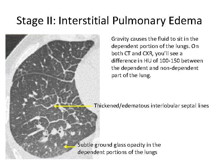 Stage II: Interstitial Pulmonary Edema Gravity causes the fluid to sit in the dependent