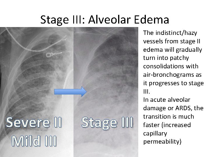 Stage III: Alveolar Edema Severe II Mild III Stage III The indistinct/hazy vessels from