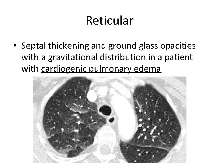 Reticular • Septal thickening and ground glass opacities with a gravitational distribution in a