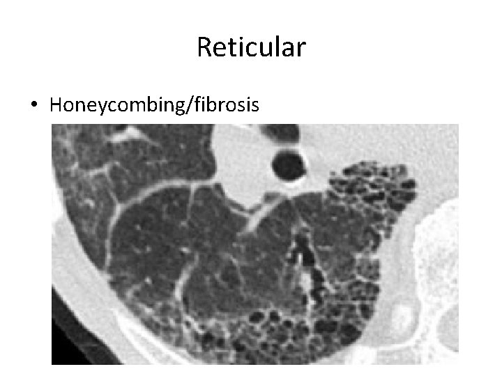 Reticular • Honeycombing/fibrosis 