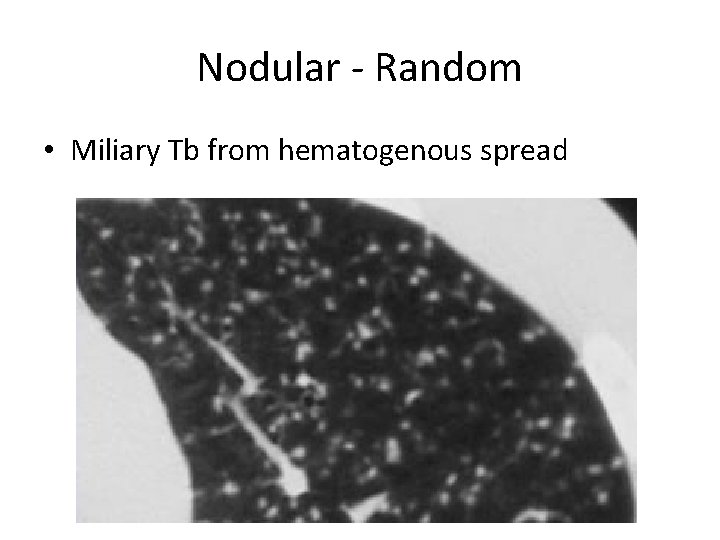 Nodular - Random • Miliary Tb from hematogenous spread 