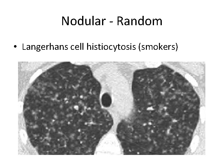 Nodular - Random • Langerhans cell histiocytosis (smokers) 