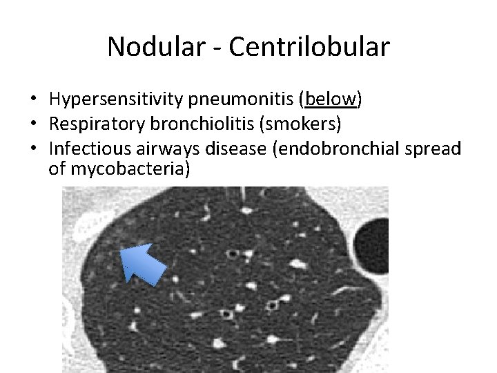 Nodular - Centrilobular • Hypersensitivity pneumonitis (below) • Respiratory bronchiolitis (smokers) • Infectious airways