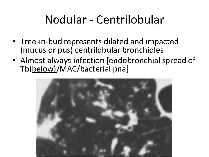 Nodular - Centrilobular • Tree-in-bud represents dilated and impacted (mucus or pus) centrilobular bronchioles