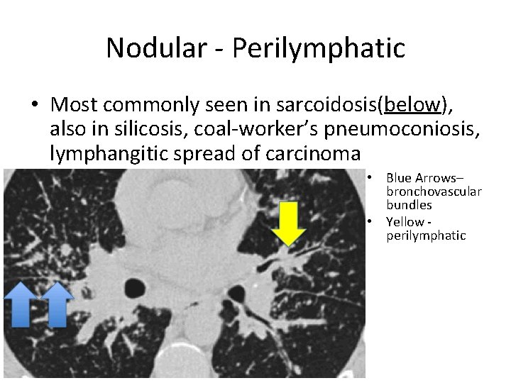 Nodular - Perilymphatic • Most commonly seen in sarcoidosis(below), also in silicosis, coal-worker’s pneumoconiosis,