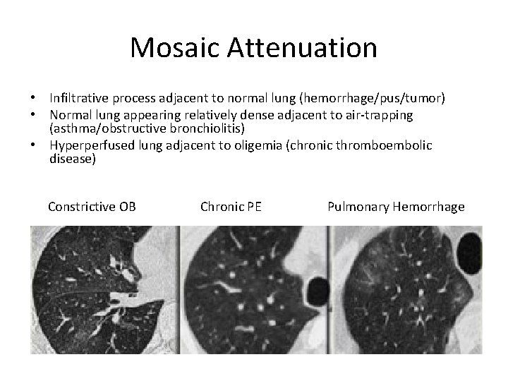 Mosaic Attenuation • Infiltrative process adjacent to normal lung (hemorrhage/pus/tumor) • Normal lung appearing