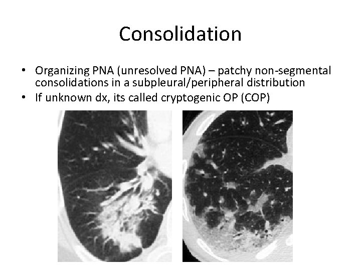Consolidation • Organizing PNA (unresolved PNA) – patchy non-segmental consolidations in a subpleural/peripheral distribution