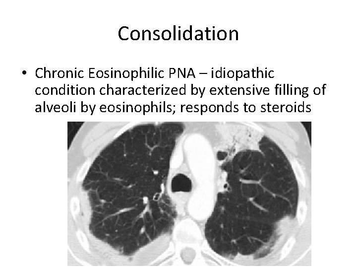 Consolidation • Chronic Eosinophilic PNA – idiopathic condition characterized by extensive filling of alveoli