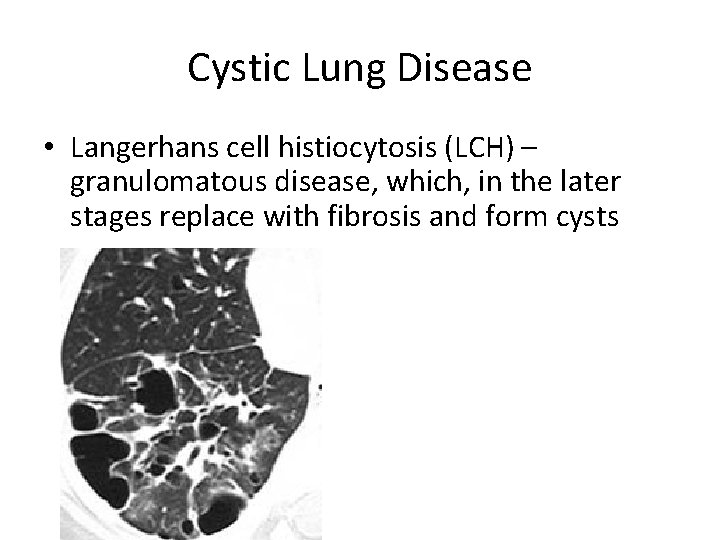 Cystic Lung Disease • Langerhans cell histiocytosis (LCH) – granulomatous disease, which, in the