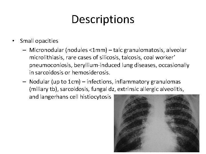 Descriptions • Small opacities – Micronodular (nodules <1 mm) – talc granulomatosis, alveolar microlithiasis,