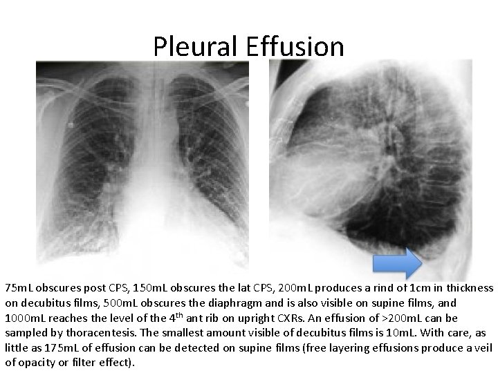 Pleural Effusion 75 m. L obscures post CPS, 150 m. L obscures the lat