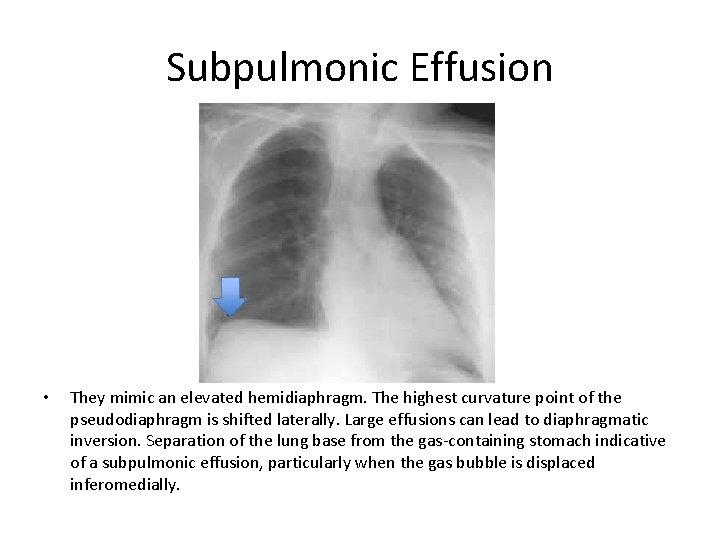 Subpulmonic Effusion • They mimic an elevated hemidiaphragm. The highest curvature point of the