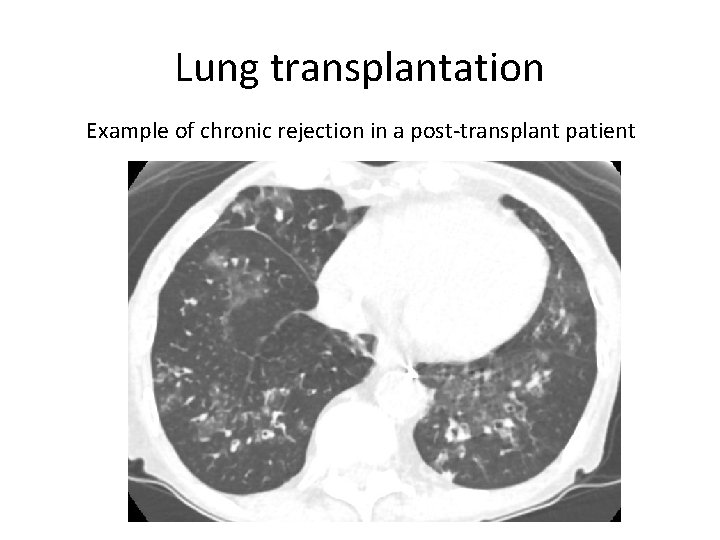 Lung transplantation Example of chronic rejection in a post-transplant patient 