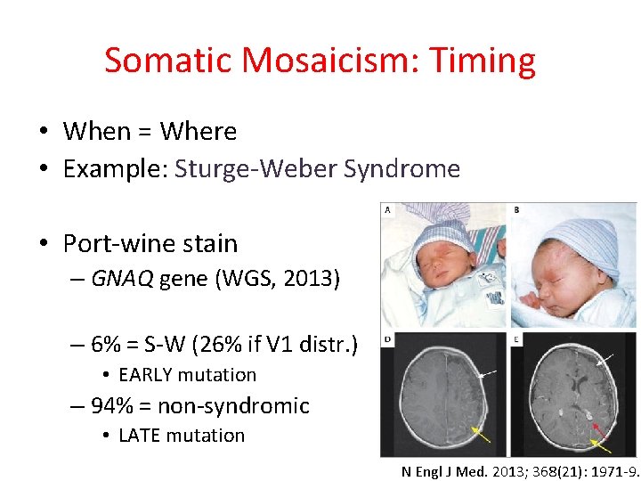 Somatic Mosaicism: Timing • When = Where • Example: Sturge-Weber Syndrome • Port-wine stain