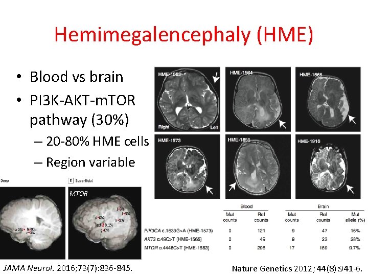 Hemimegalencephaly (HME) • Blood vs brain • PI 3 K-AKT-m. TOR pathway (30%) –