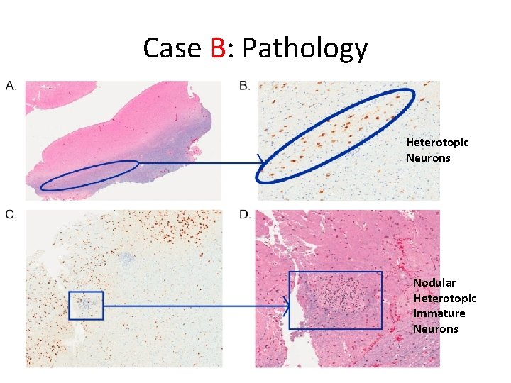 Case B: Pathology Heterotopic Neurons Nodular Heterotopic Immature Neurons 