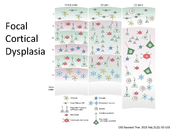 Focal Cortical Dysplasia CNS Neurosci Ther. 2015 Feb; 21(2): 92– 103. 