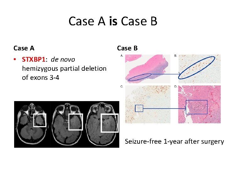 Case A is Case B Case A Case B • STXBP 1: de novo