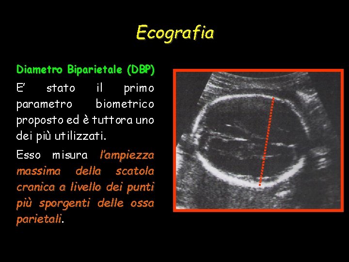 Ecografia Diametro Biparietale (DBP) E’ stato il primo parametro biometrico proposto ed è tuttora