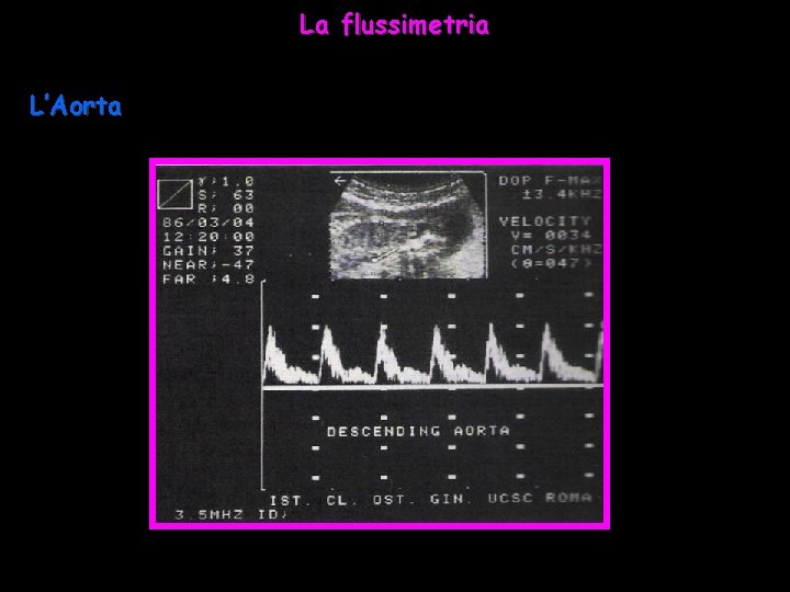 La flussimetria L’Aorta 