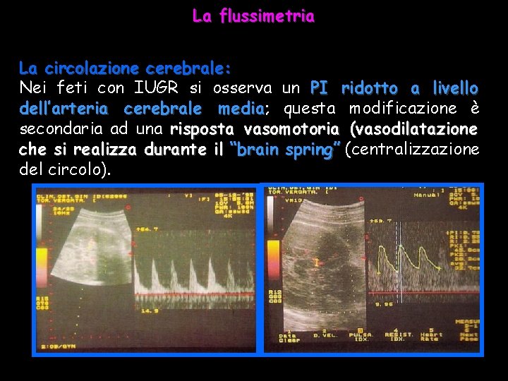 La flussimetria La circolazione cerebrale: Nei feti con IUGR si osserva un PI ridotto