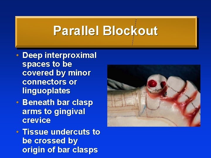 Parallel Blockout • Deep interproximal spaces to be covered by minor connectors or linguoplates