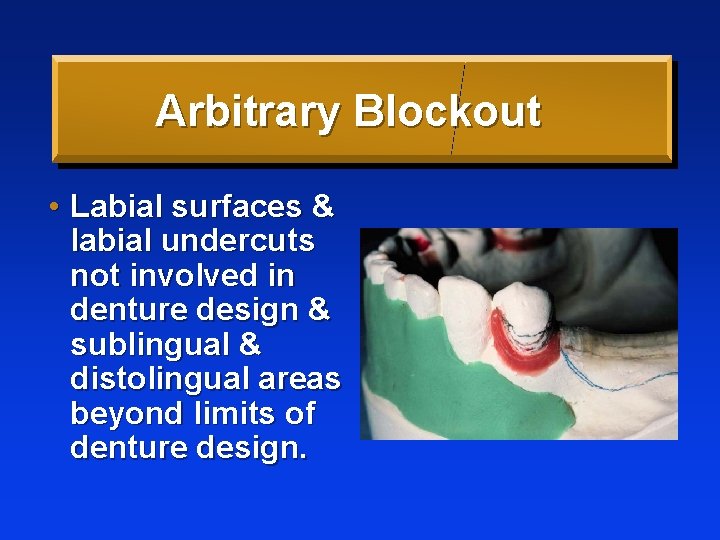 Arbitrary Blockout • Labial surfaces & labial undercuts not involved in denture design &