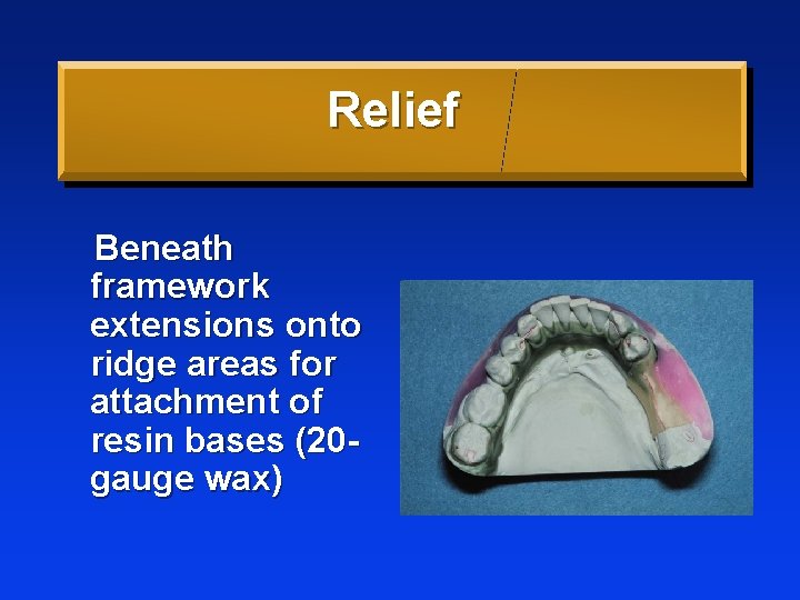 Relief Beneath framework extensions onto ridge areas for attachment of resin bases (20 gauge