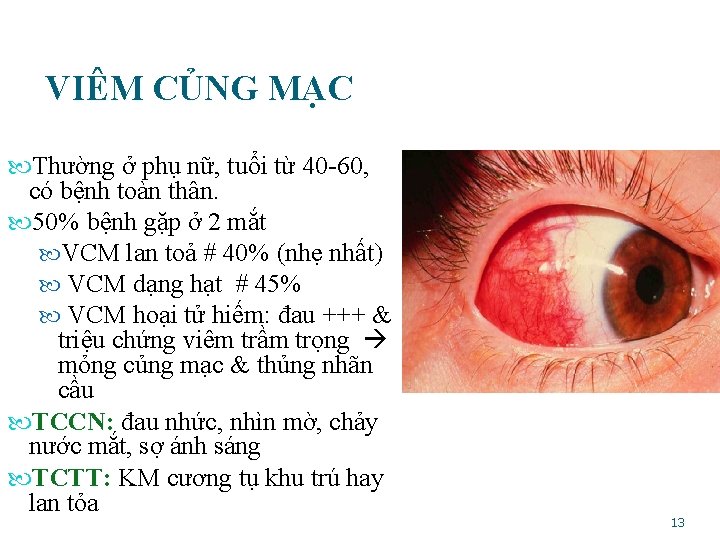  VIÊM CỦNG MẠC Thường ở phụ nữ, tuổi từ 40 -60, có bệnh