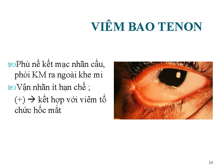  VIÊM BAO TENON Phù nề kết mạc nhãn cầu, phòi KM ra ngoài