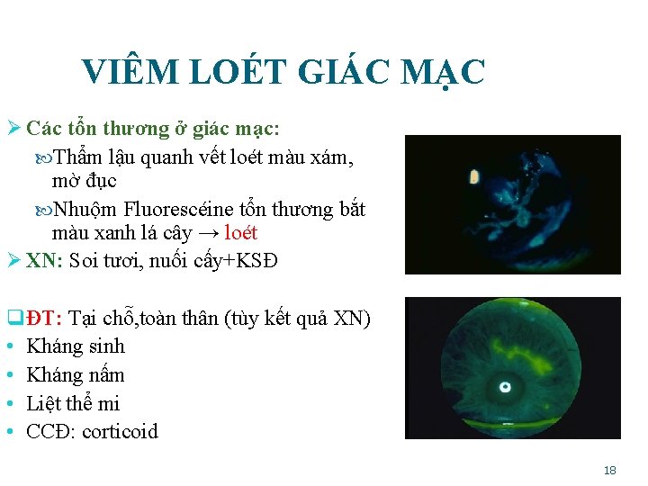 VIÊM LOÉT GIÁC MẠC Ø Các tổn thương ở giác mạc: Thẩm lậu quanh