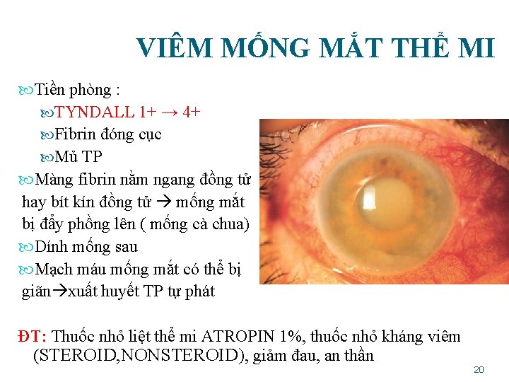 VIÊM MỐNG MẮT THỂ MI Tiền phòng : TYNDALL 1+ → 4+ Fibrin đóng