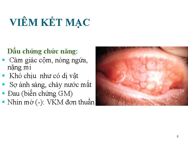 VIÊM KẾT MẠC § § § Dấu chứng chức năng: Cảm giác cộm, nóng