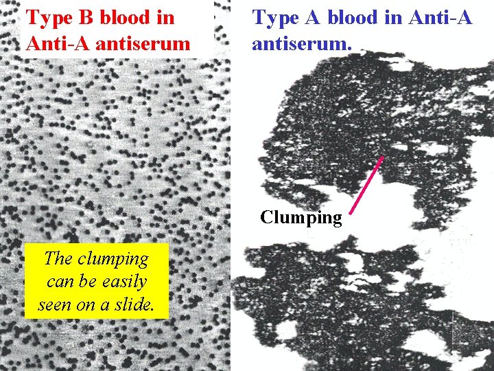 Type B blood in Anti-A antiserum Type A blood in Anti-A antiserum. Clumping The