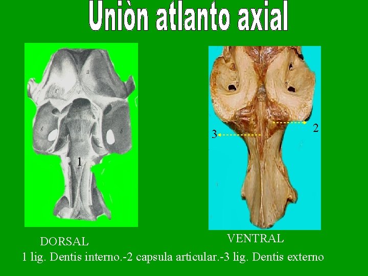 3 2 1 VENTRAL DORSAL 1 lig. Dentis interno. -2 capsula articular. -3 lig.