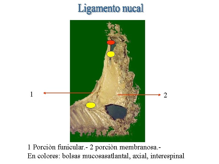 1 2 1 Porciòn funicular. - 2 porciòn membranosa. En colores: bolsas mucosasatlantal, axial,