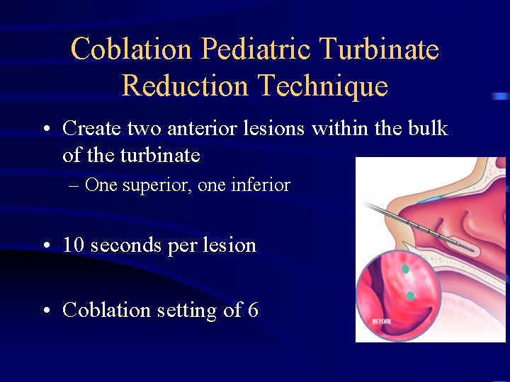 Coblation Pediatric Turbinate Reduction Technique • Create two anterior lesions within the bulk of