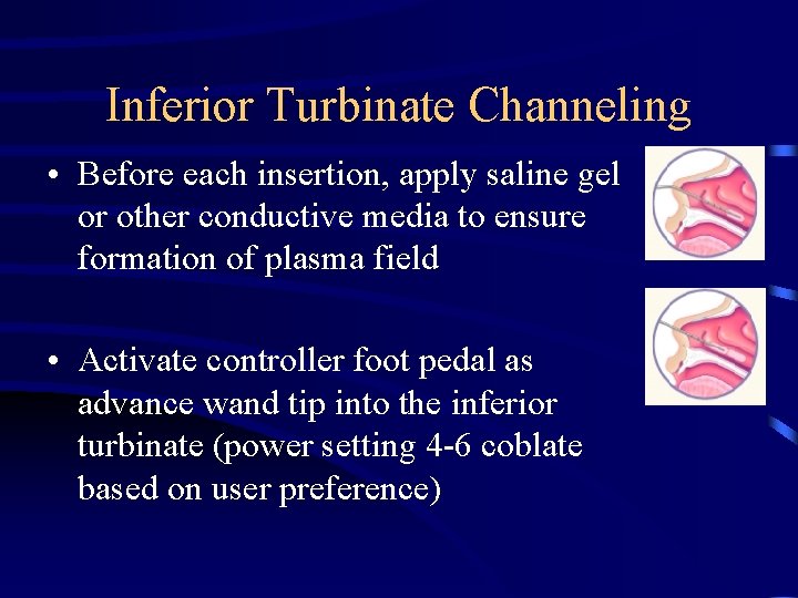Inferior Turbinate Channeling • Before each insertion, apply saline gel or other conductive media