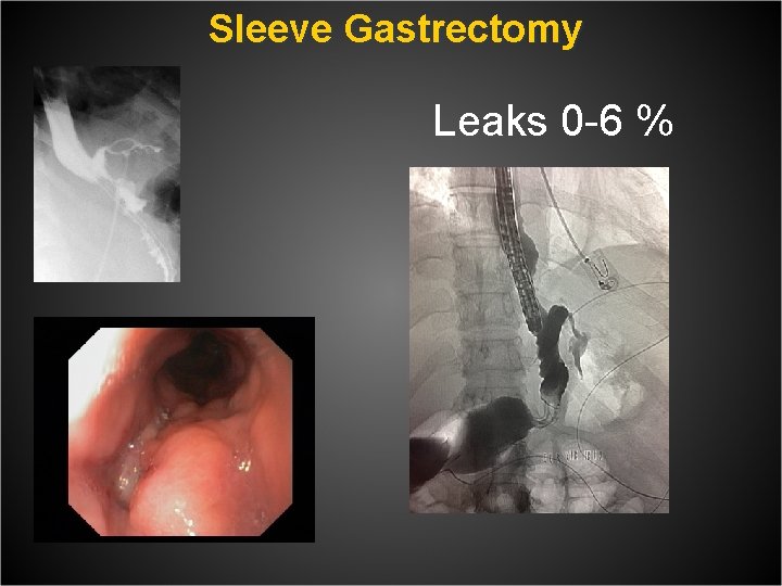  Sleeve Gastrectomy Leaks 0 -6 % 