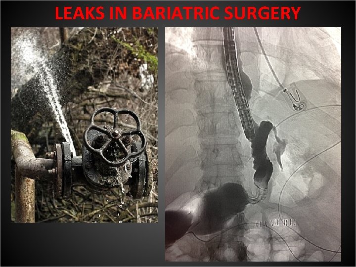 LEAKS IN BARIATRIC SURGERY 