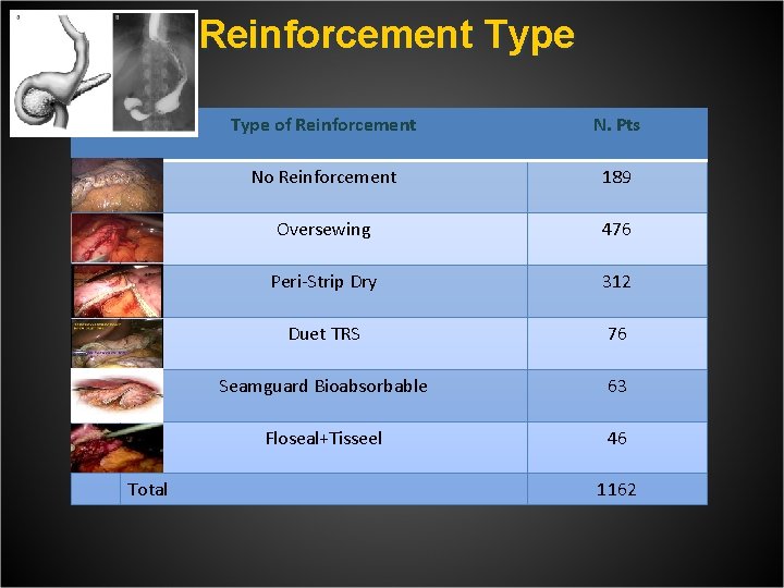 Reinforcement Type Total Type of Reinforcement N. Pts No Reinforcement 189 Oversewing 476 Peri-Strip