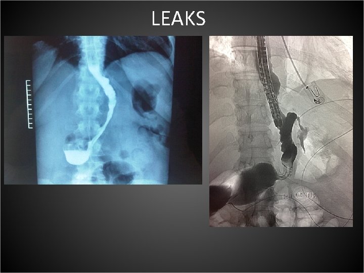 LEAKS 