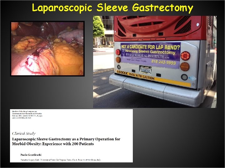 Laparoscopic Sleeve Gastrectomy 