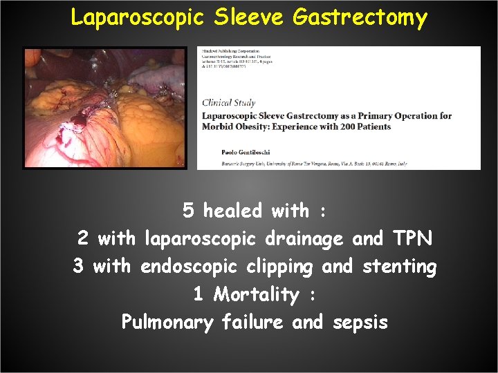 Laparoscopic Sleeve Gastrectomy 5 healed with : 2 with laparoscopic drainage and TPN 3