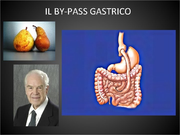 IL BY-PASS GASTRICO 