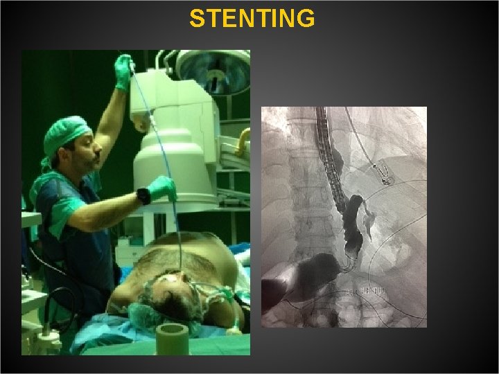  STENTING 